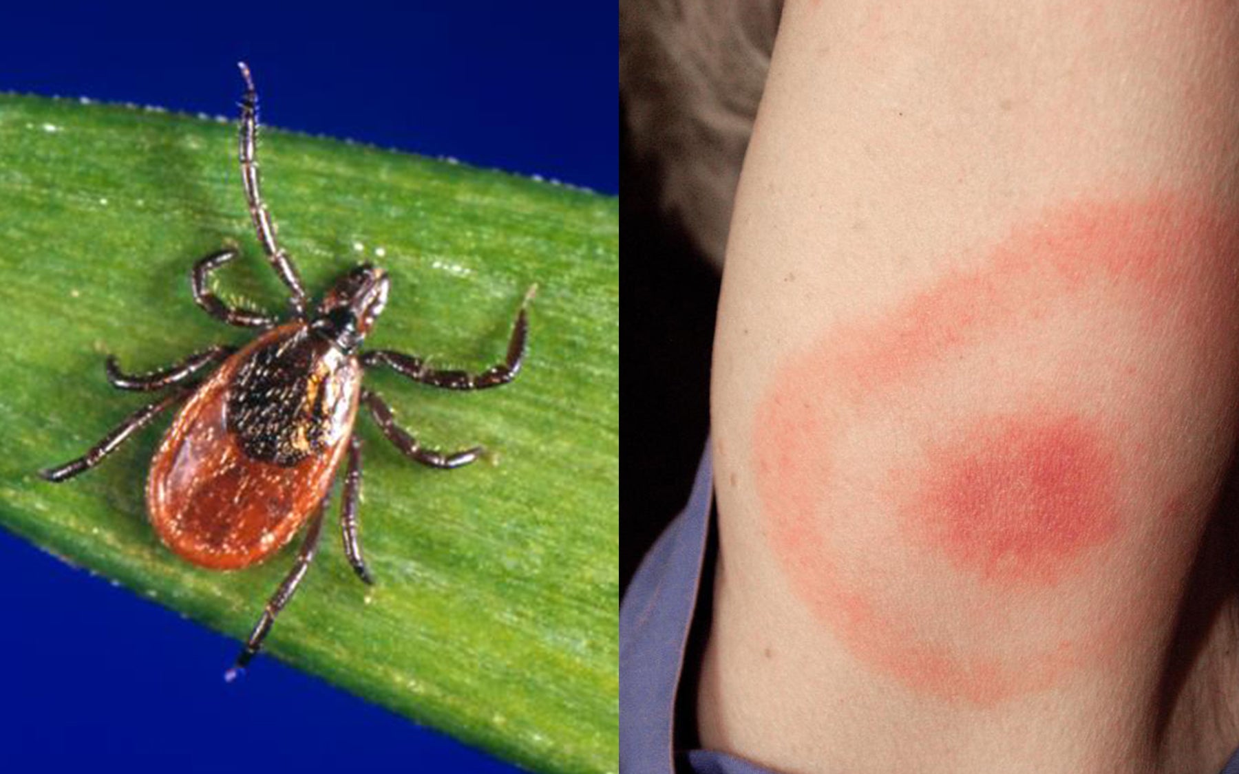 Ixodes Tick (Left) and Bite Lyme Disease Symptoms (Right)